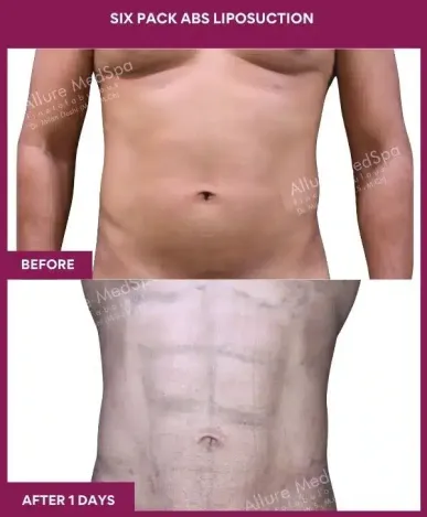 8- Six Pack Abs Liposuction