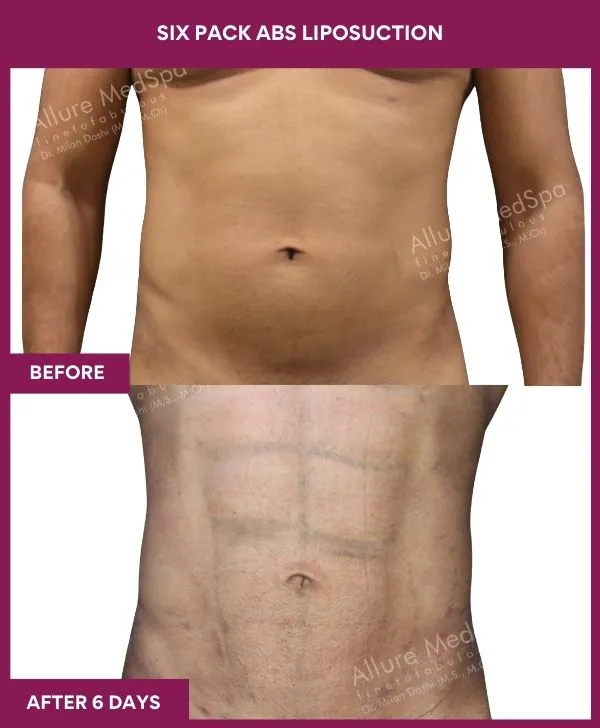 8 Six Pack Abs Liposuction (4)_64