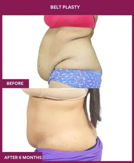 9 BELT PLASTY_15_ (3)