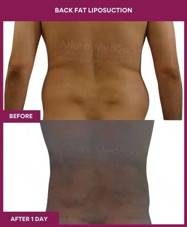 9 Back Fat Liposuction_42