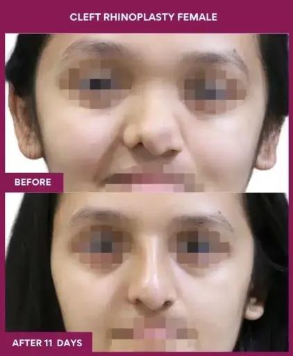 9 cleft rhinoplasty female_31 in Mumbai, India