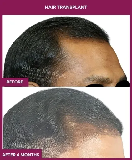 2 Hair Transplant (5)_4_