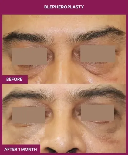 3 BLEPHEROPLASTY (6)_7_