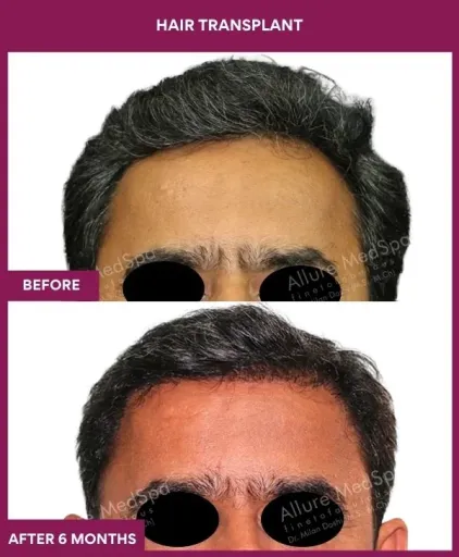 3 Hair Transplant_8 (1)