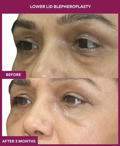LOWER LID BLEPHEROPLASTY Surgery In Mumbai, India