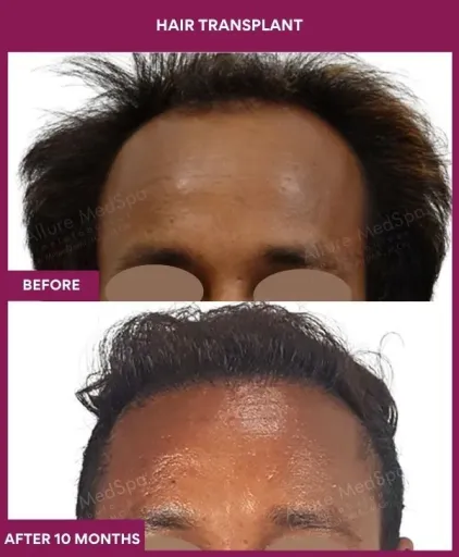 5 Hair Transplant_13_1 (1)