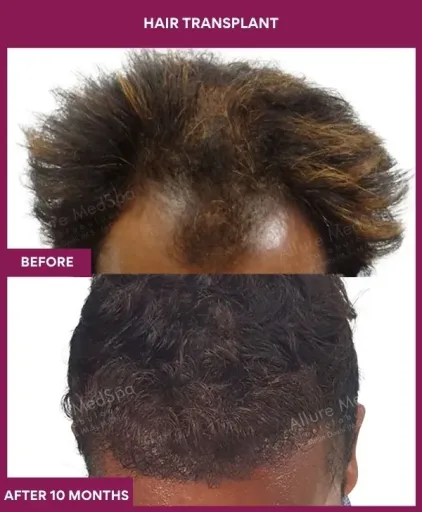 5 Hair Transplant_13_1 (2)