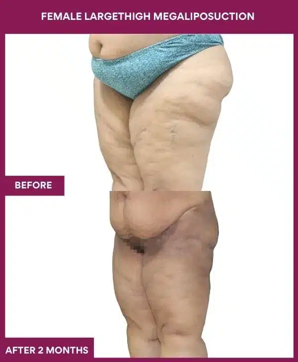 FEMALE LARGE THIGH MEGA LIPOSUCTION in Mumbai, India