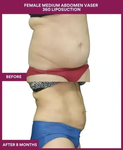 FEMALE MEDIUM ABDOMEN VASER 360 LIPOSUCTION in Mumbai, India