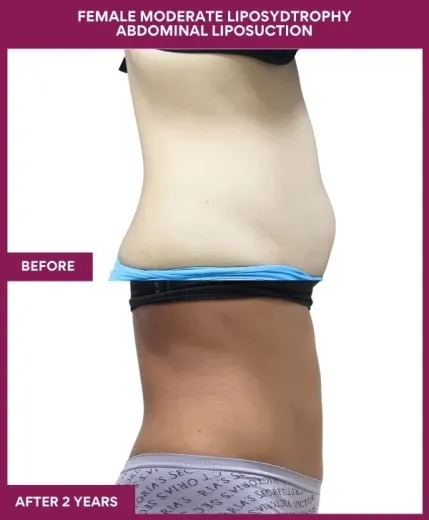 FEMALE MODERATE LIPOSYDTROPHY ABDOMINAL LIPOSUCTION in Mumbai, India