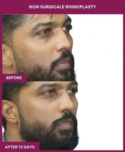 Non-surgical rhinoplasty before and after right side view in Mumbai, India