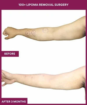 1 100+ Lipoma Removal Surgery (2)