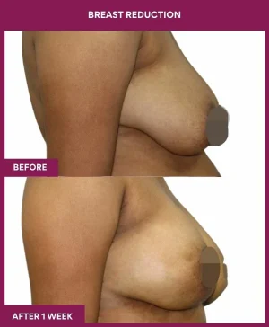 1 BREAST REDUCTION (3)