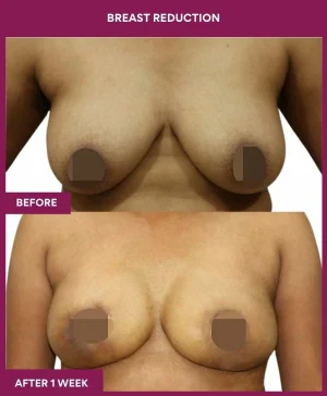 1 BREAST REDUCTION