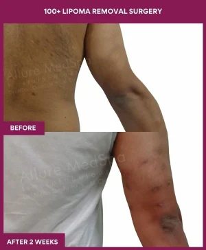 10 100+ Lipoma Removal Surgery (4)