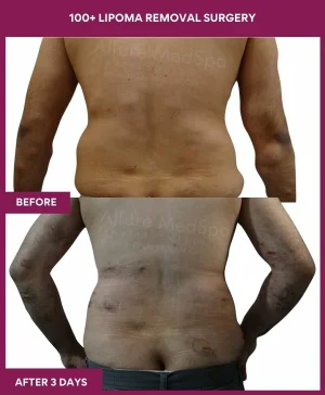 11 100+ Lipoma Removal Surgery (2)