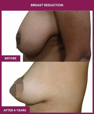 3 BREAST REDUCTION (3)