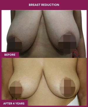 3 BREAST REDUCTION