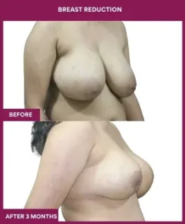 3- Breast Reduction_9_ (2)