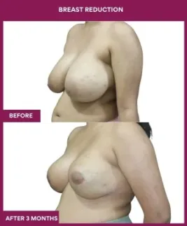 3- Breast Reduction_9_ (3)