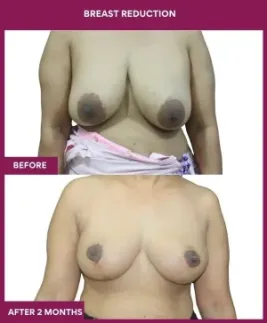 4-Breast Reduction_12_ (1)