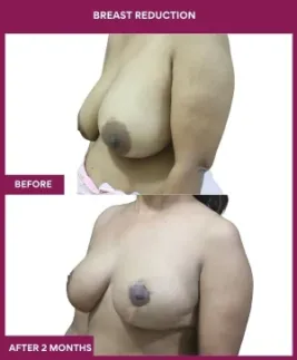 4-Breast Reduction_12_ (3)