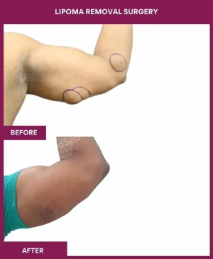 5 Lipoma Removal Surgery