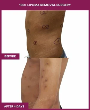 7 100+ Lipoma Removal Surgery (3)