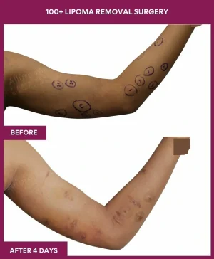 8 100+ Lipoma Removal Surgery