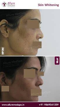 Skin-Lightening-Before-and-After-Images