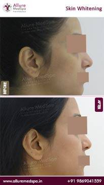 Skin-Whitening-Before-and-After-Images