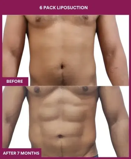 6 Pack Liposuction Before After Image in Mumbai, India