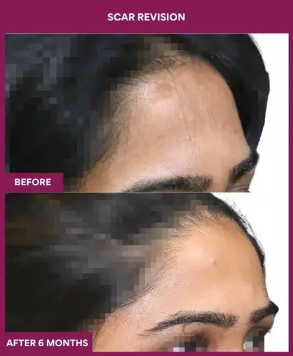 Scar Revision Before After image in Mumbai, India