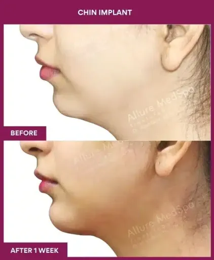 1 Chin Implant in Mumbai, India