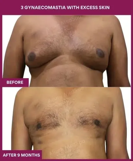 10-3 gynaecomastia with excess skin_