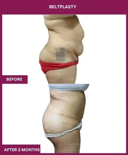 10 BELTPLASTY_21_ (5)