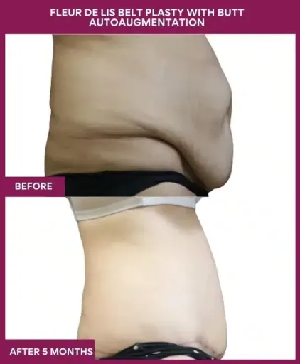 11 Fleur de lis Belt plasty with butt autoaugmentation_ (3)