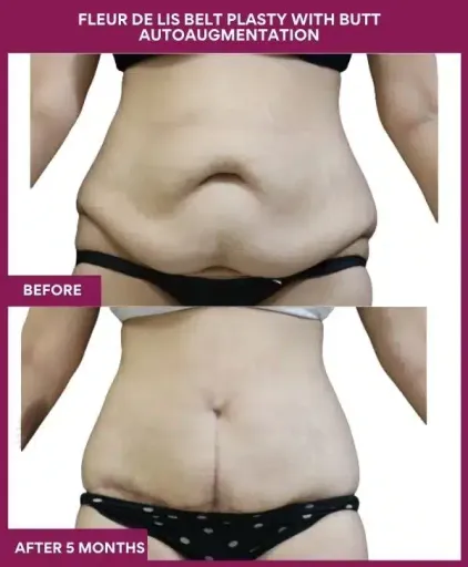 11 Fleur de lis Belt plasty with butt autoaugmentation_ (4)