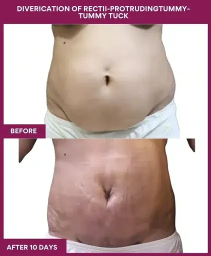 12 DIVERICATION OF RECTII-PROTRUDINGTUMMY- TUMMY TUCK (4)_7_
