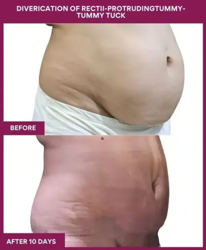 12 DIVERICATION OF RECTII-PROTRUDINGTUMMY- TUMMY TUCK (5)_7_