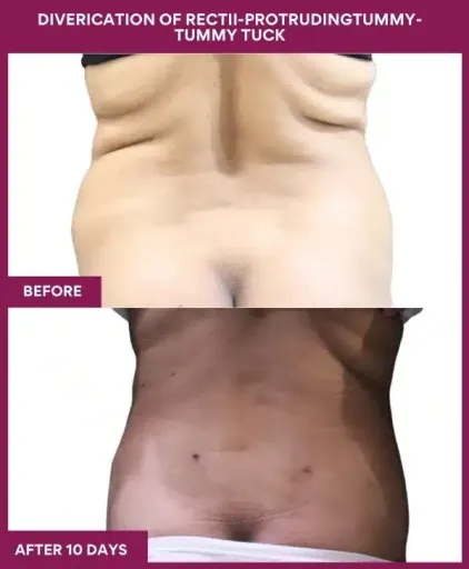 12 DIVERICATION OF RECTII-PROTRUDINGTUMMY- TUMMY TUCK (6)_7_