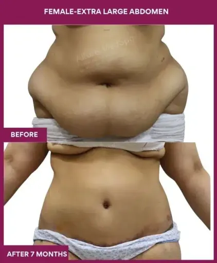 13 FEMALE-EXTRA LARGE ABDOMEN_ (1)