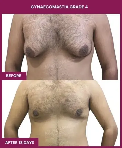 13- GYNAECOMASTIA GRADE 4_