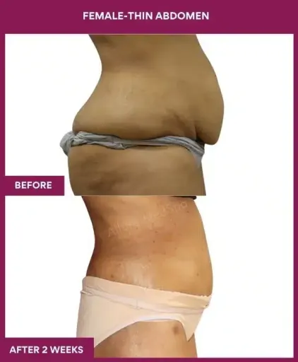 14 FEMALE-THIN ABDOMEN_18_ (3)