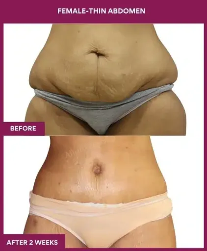 14 FEMALE-THIN ABDOMEN_18_ (4)