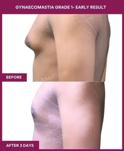 2- GYNAECOMASTIA GRADE 1- EARLY RESULT (3)