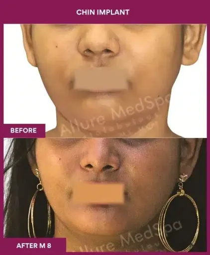 3 Chin Implant in Mumbai, India