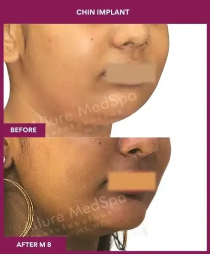 3 Chin Implant in Mumbai, India