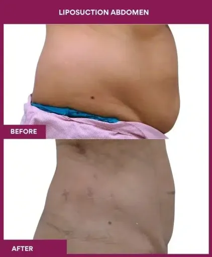 3- liposuction abdomen-