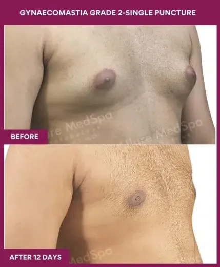 5-GYNAECOMASTIA GRADE 2-SINGLE PUNCTURE (2)_